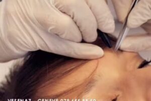 D-FINITIV – Epilazione definitiva elettrica elettrolisi elettroepilazione Genève